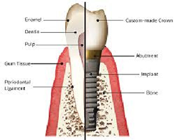Prothèse dentaire en coupe